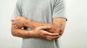 Minas Gerais confirma três casos de mpox; Brasil soma 62 sem óbitos.