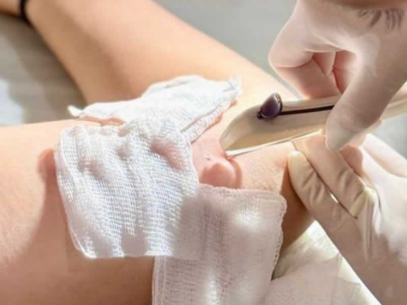 Timóteo amplia rede de saúde com implante contraceptivo e DIU hormonal soaquinoticias