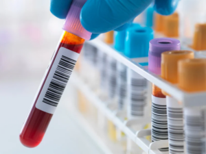 Novo exame de sangue para Alzheimer chega ao Brasil e facilita diagnóstico soaquinoticias
